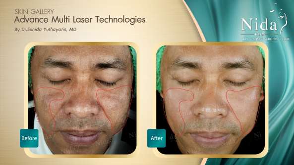 B&A ฝ้า case1-1_0