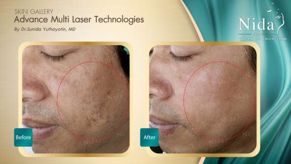 B&A ฝ้า case1-2_0