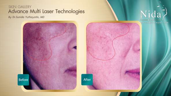 B&A ฝ้า case10-1_0