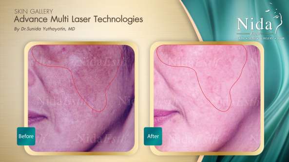 B&A ฝ้า case10-2_0
