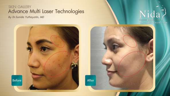 B&A ฝ้า case2-1_0