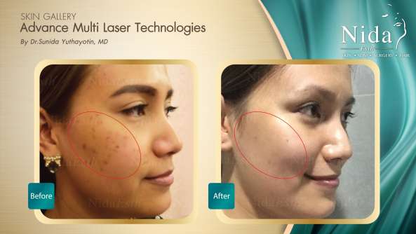 B&A ฝ้า case2-2_0