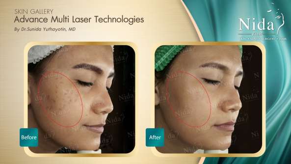 B&A ฝ้า case2-3_0