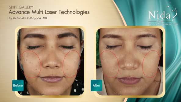 B&A ฝ้า case2-4_0