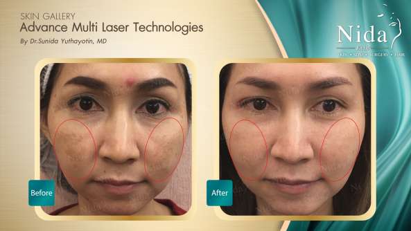 B&A ฝ้า case3-1_0