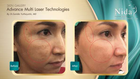 B&A ฝ้า case3-2_0