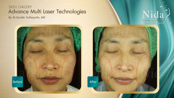 B&A ฝ้า case4-1_0