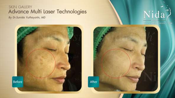B&A ฝ้า case4-2_0